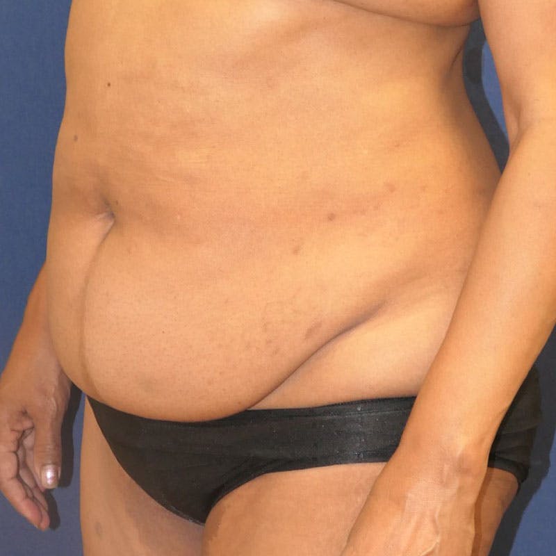Tummy Tuck (Abdominoplasty) Before & After Gallery - Patient 162150 - Image 9