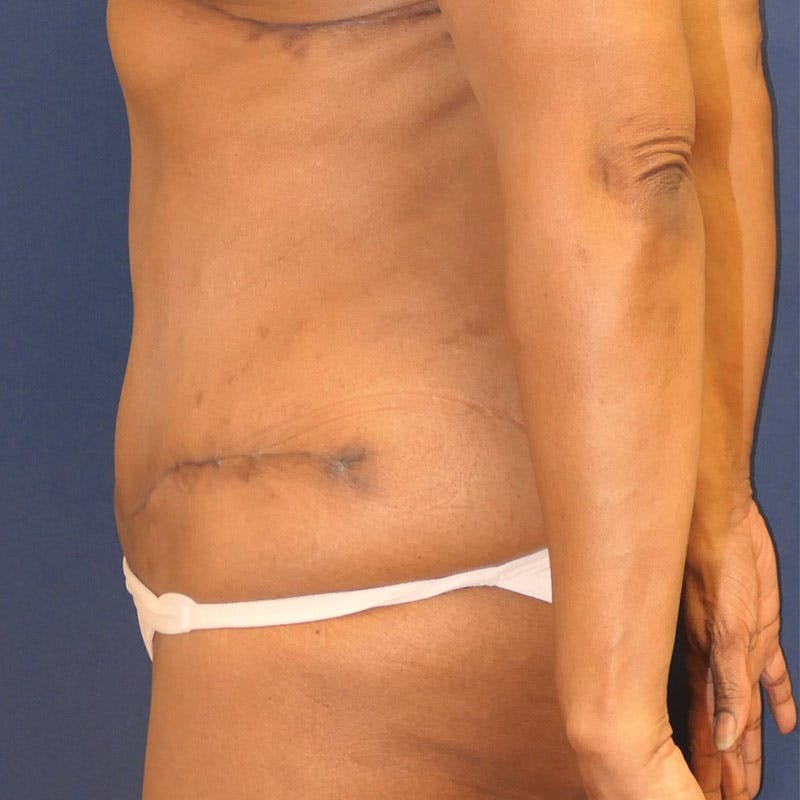 Tummy Tuck (Abdominoplasty) Before & After Gallery - Patient 162150 - Image 8