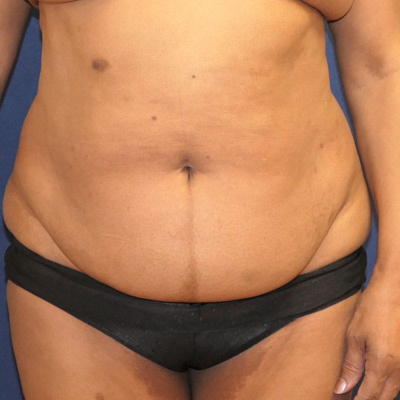 Tummy Tuck (Abdominoplasty) Before & After Gallery - Patient 162150 - Image 1