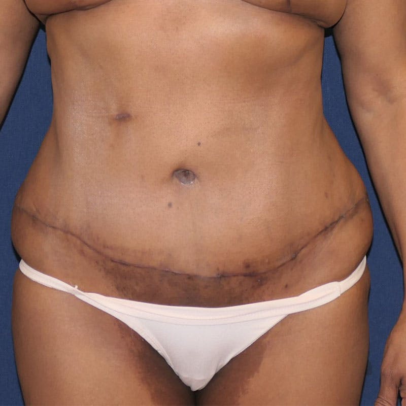 Tummy Tuck (Abdominoplasty) Before & After Gallery - Patient 162150 - Image 2