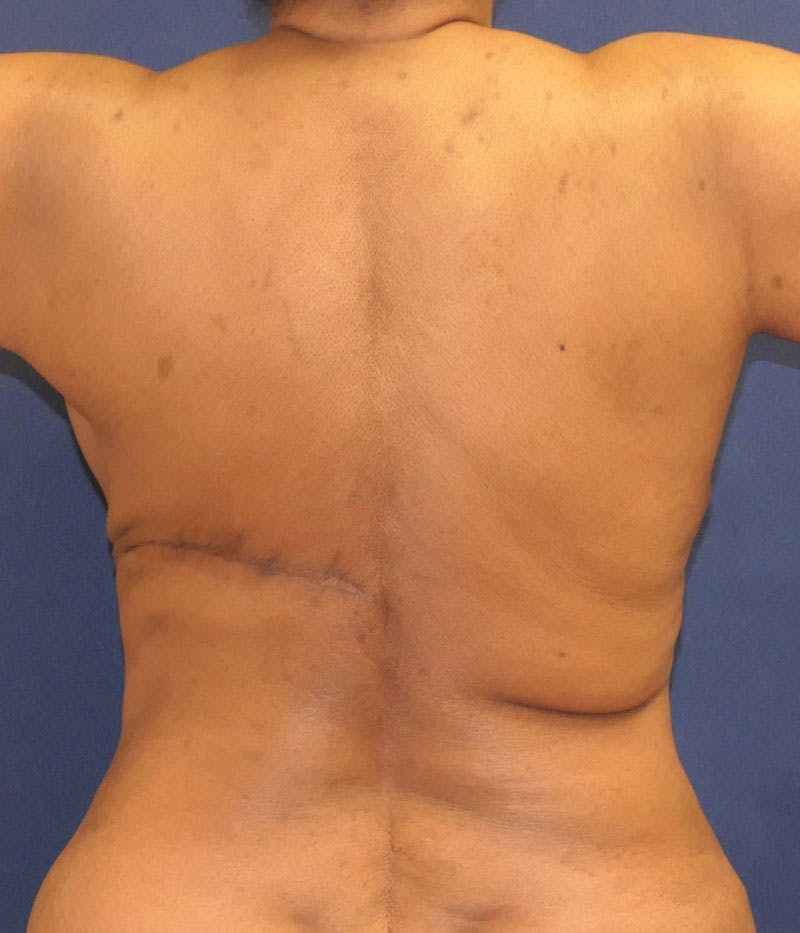 Breast Reconstruction with Autologous Tissue Before & After Gallery - Patient 350970 - Image 8