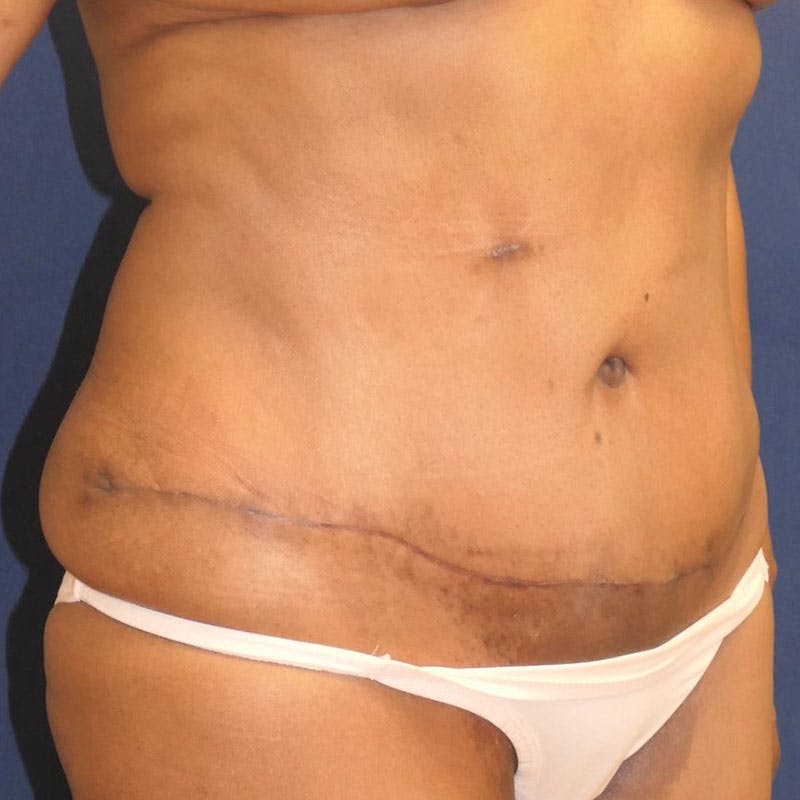 Tummy Tuck (Abdominoplasty) Before & After Gallery - Patient 162150 - Image 4