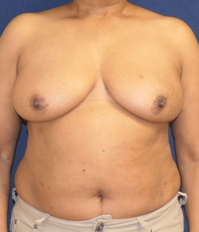 Breast Reconstruction with Autologous Tissue Before & After Gallery - Patient 350970 - Image 1