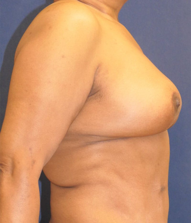 Breast Reconstruction with Autologous Tissue Before & After Gallery - Patient 350970 - Image 12