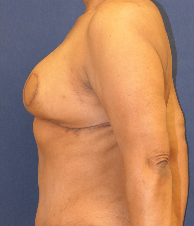 Breast Reconstruction with Autologous Tissue Before & After Gallery - Patient 350970 - Image 6