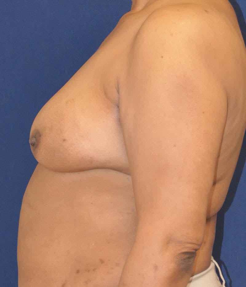 Breast Reconstruction with Autologous Tissue Before & After Gallery - Patient 350970 - Image 5