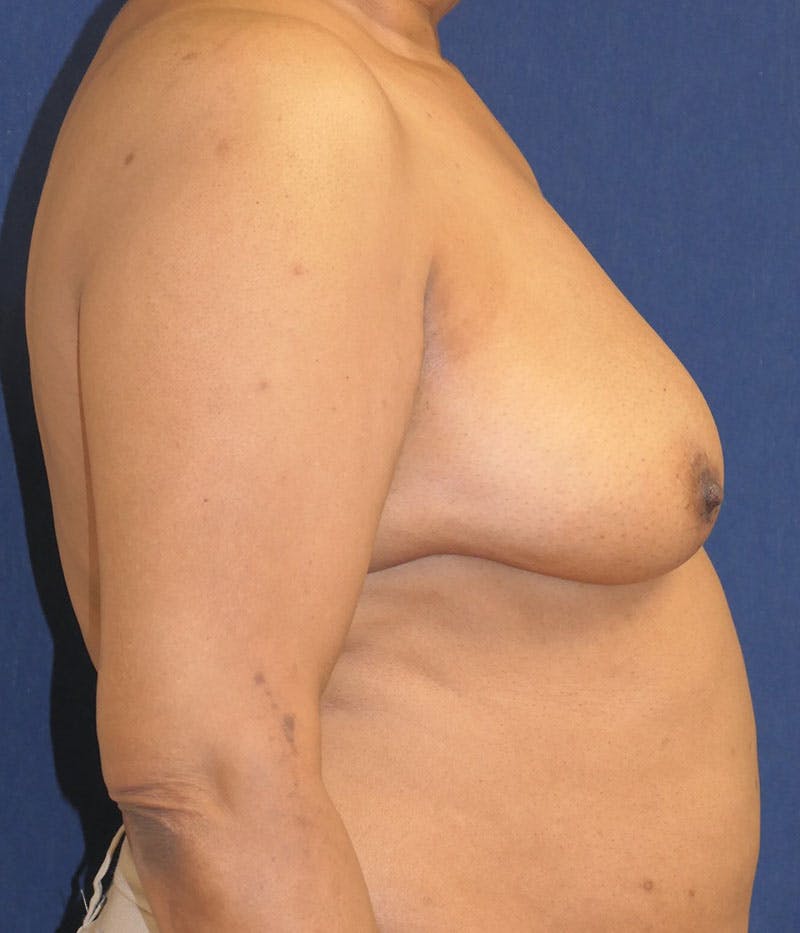 Breast Reconstruction with Autologous Tissue Before & After Gallery - Patient 350970 - Image 11