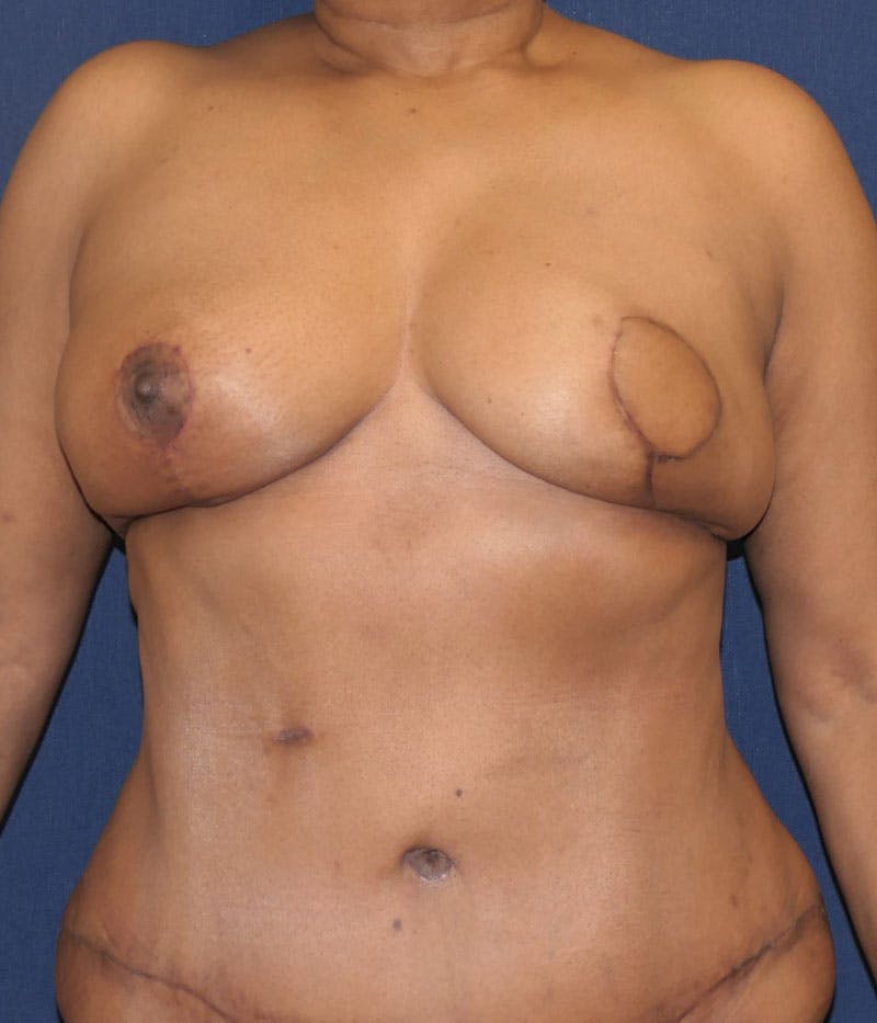 Breast Reconstruction with Autologous Tissue Before & After Gallery - Patient 350970 - Image 2