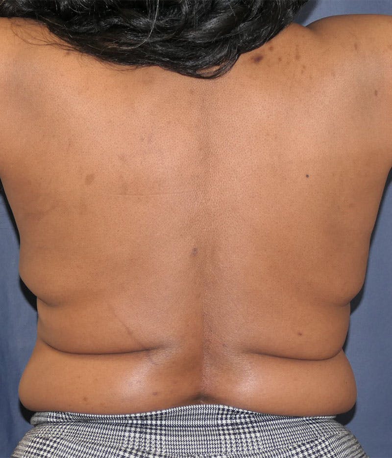 Breast Reconstruction with Autologous Tissue Before & After Gallery - Patient 350970 - Image 7