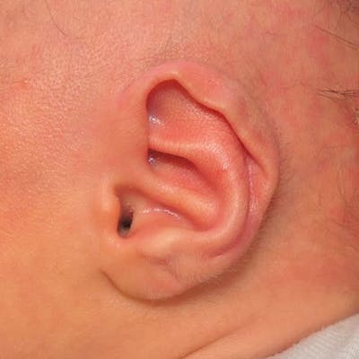 Pediatric Ear Molding Before & After Gallery - Patient 408373 - Image 1