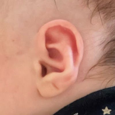 Pediatric Ear Molding Before & After Gallery - Patient 408373 - Image 2