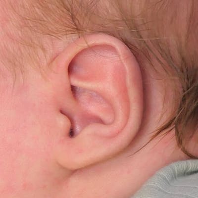 Pediatric Ear Molding Before & After Gallery - Patient 221436 - Image 1
