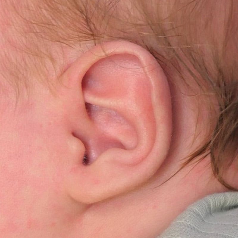 Pediatric Ear Molding Before & After Gallery - Patient 221436 - Image 1