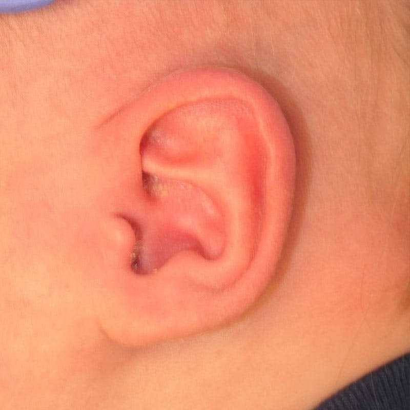 Pediatric Ear Molding Before & After Gallery - Patient 221436 - Image 2