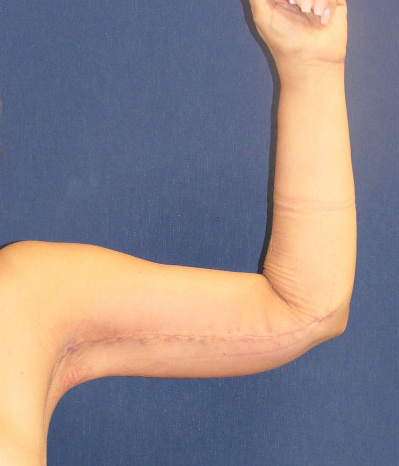 Arm Lift (Brachioplasty) Before & After Gallery - Patient 332909 - Image 8