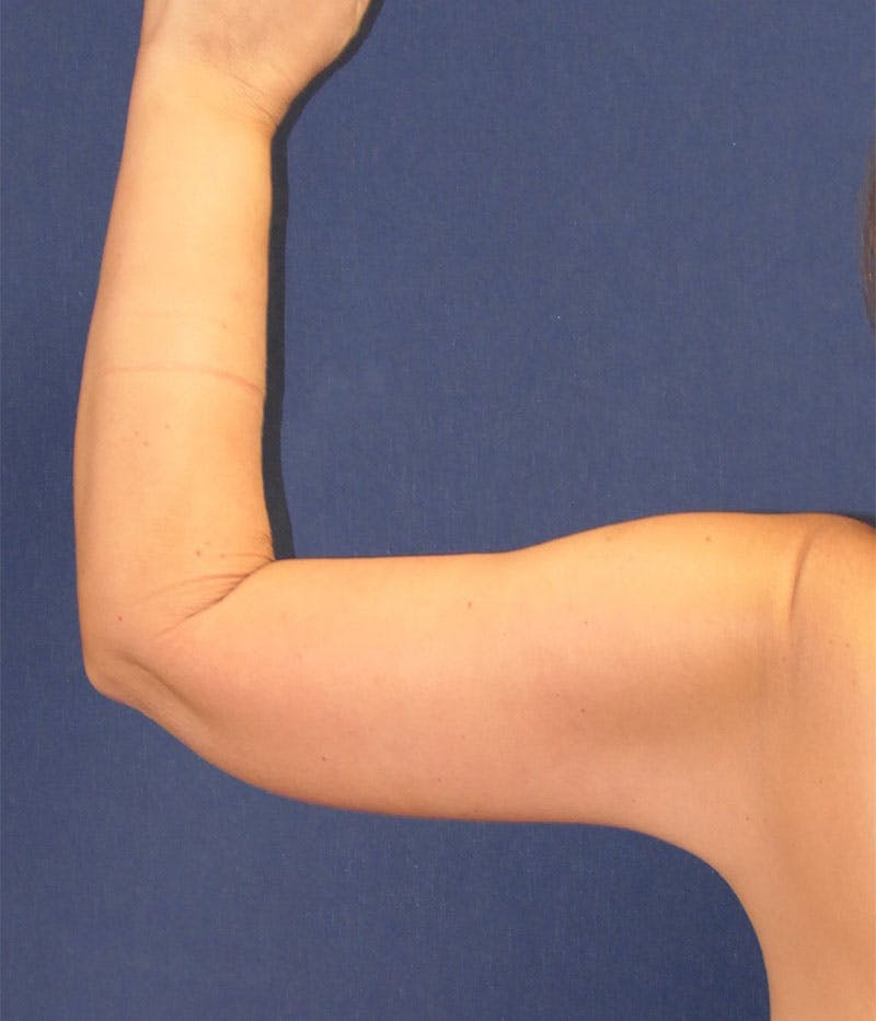 Arm Lift (Brachioplasty) Before & After Gallery - Patient 332909 - Image 6