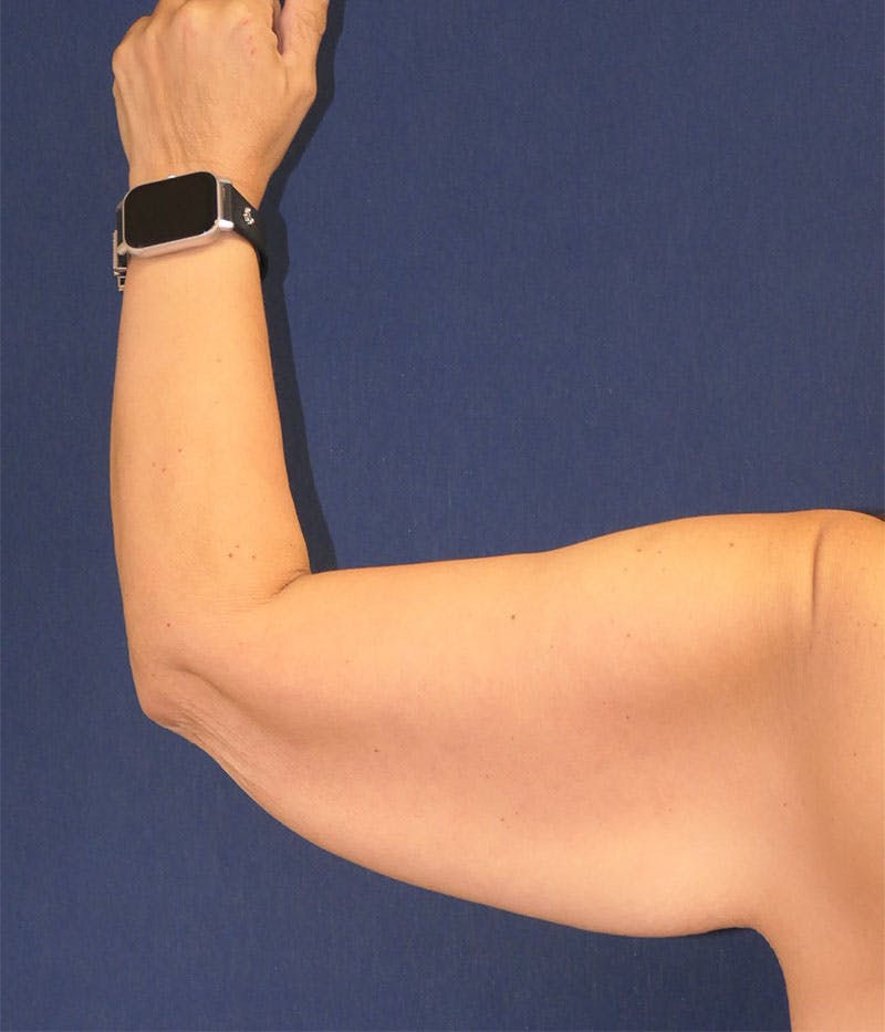 Arm Lift (Brachioplasty) Before & After Gallery - Patient 332909 - Image 5