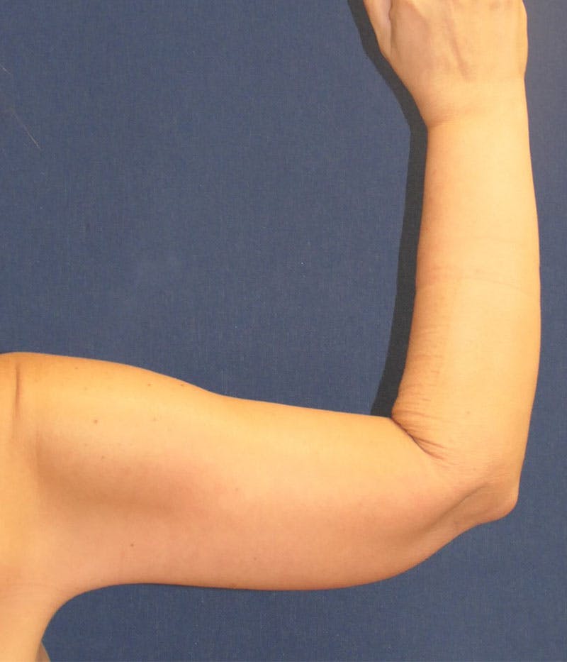 Arm Lift (Brachioplasty) Before & After Gallery - Patient 332909 - Image 2