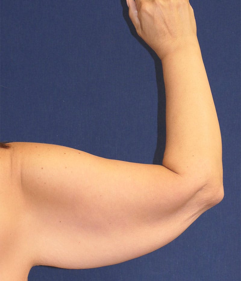 Arm Lift (Brachioplasty) Before & After Gallery - Patient 332909 - Image 1