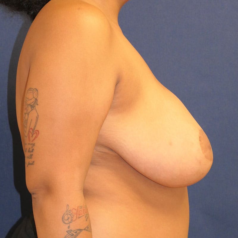 Breast Reduction Before & After Gallery - Patient 132838 - Image 6