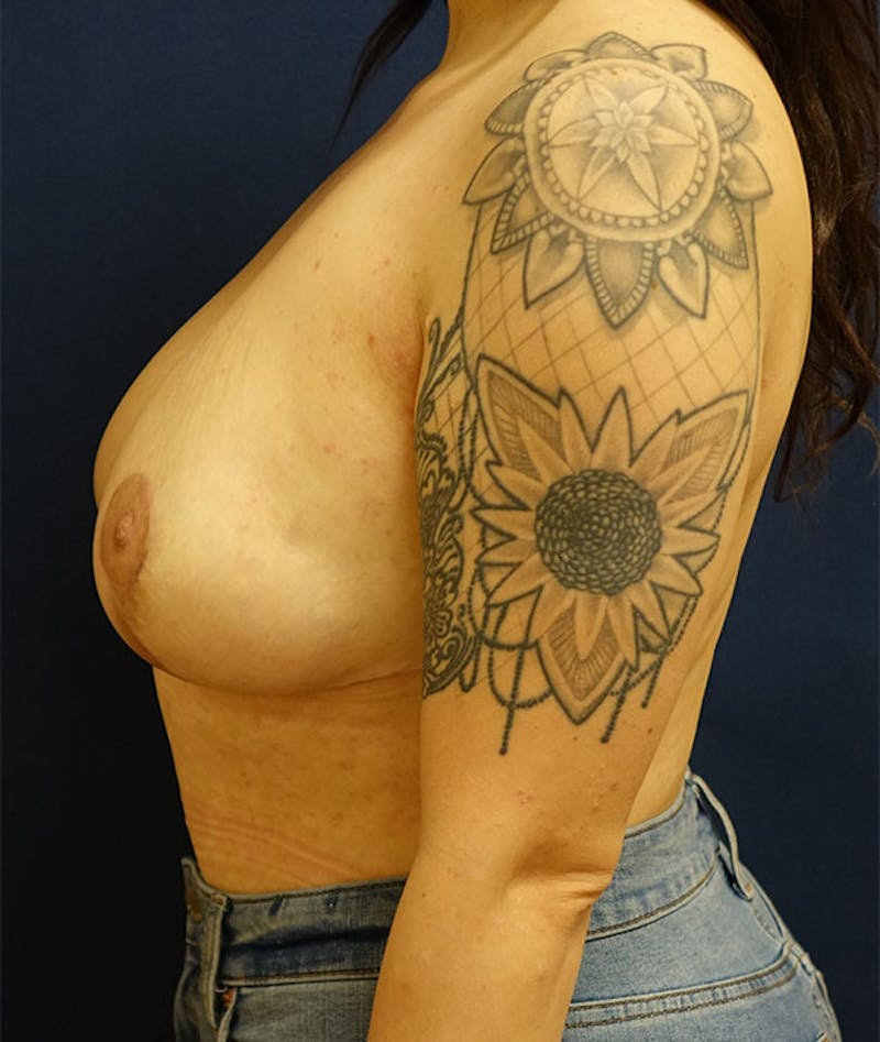 Breast Reduction Before & After Gallery - Patient 360088 - Image 4