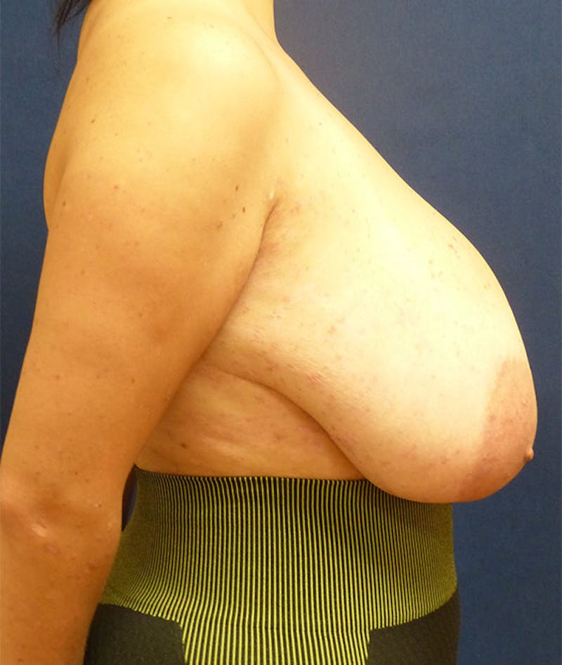 Breast Reduction Before & After Gallery - Patient 360088 - Image 9