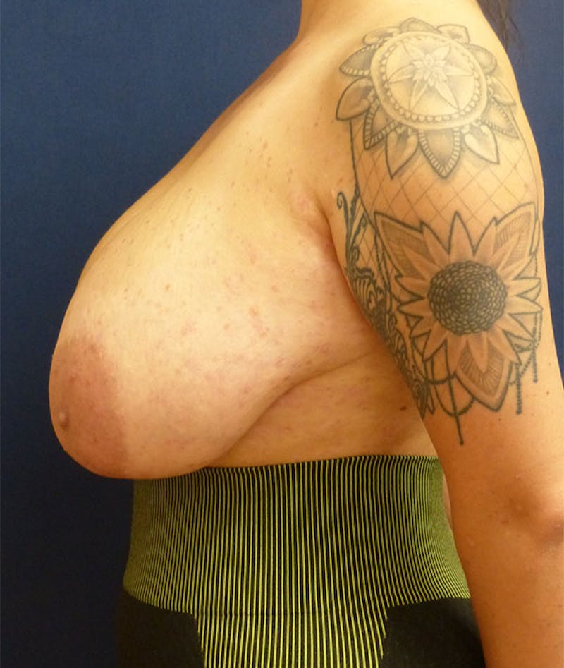 Breast Reduction Before & After Gallery - Patient 360088 - Image 3