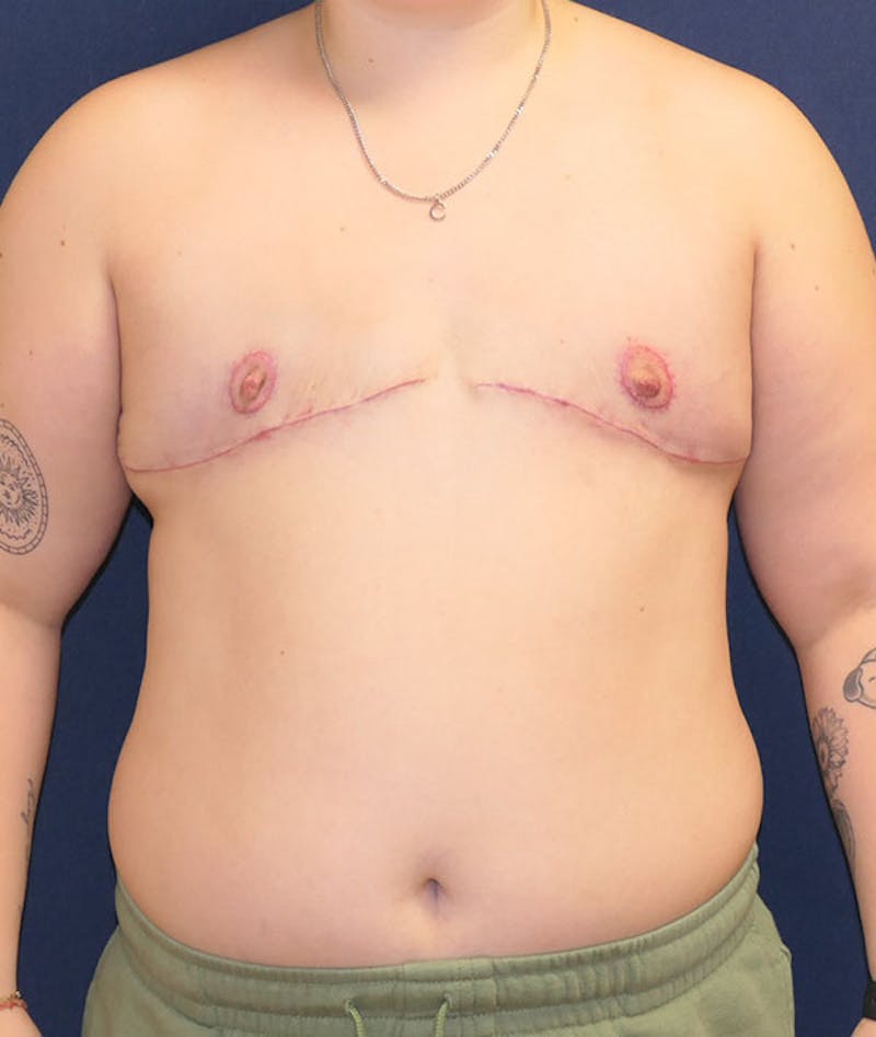 Masculinizing Surgery Before & After Gallery - Patient 439332 - Image 2