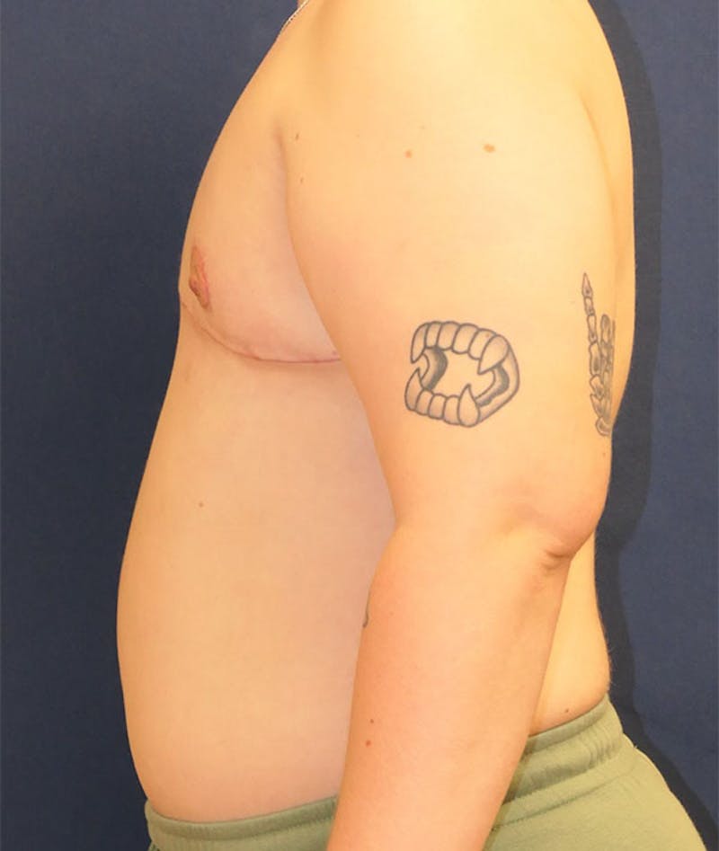 Masculinizing Surgery Before & After Gallery - Patient 439332 - Image 4
