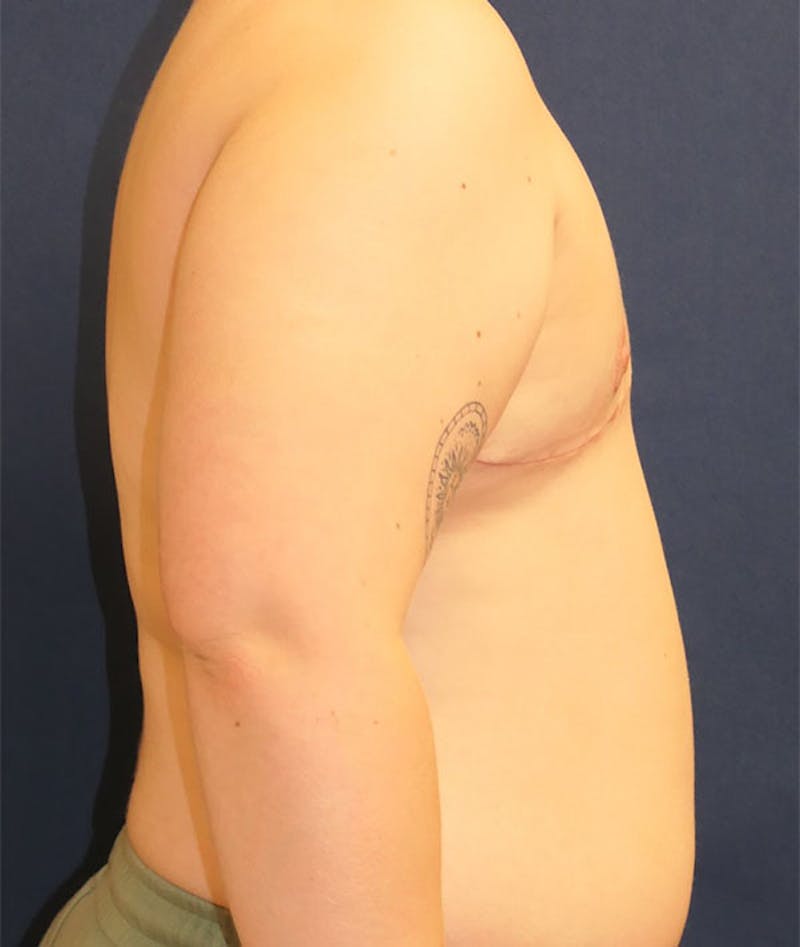 Masculinizing Surgery Before & After Gallery - Patient 439332 - Image 6