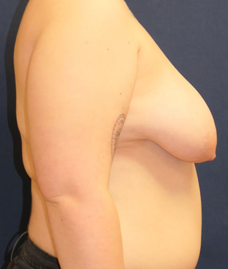 Masculinizing Surgery Before & After Gallery - Patient 439332 - Image 5