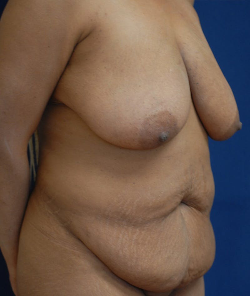Mommy Makeover Before & After Gallery - Patient 151409 - Image 3