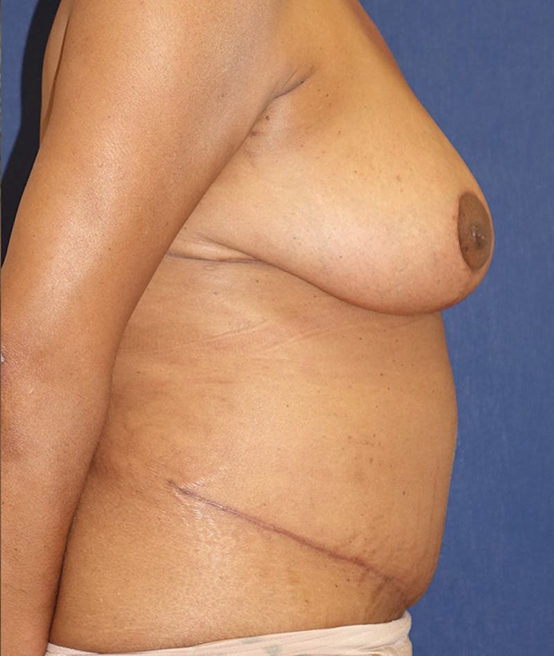 Mommy Makeover Before & After Gallery - Patient 151409 - Image 6
