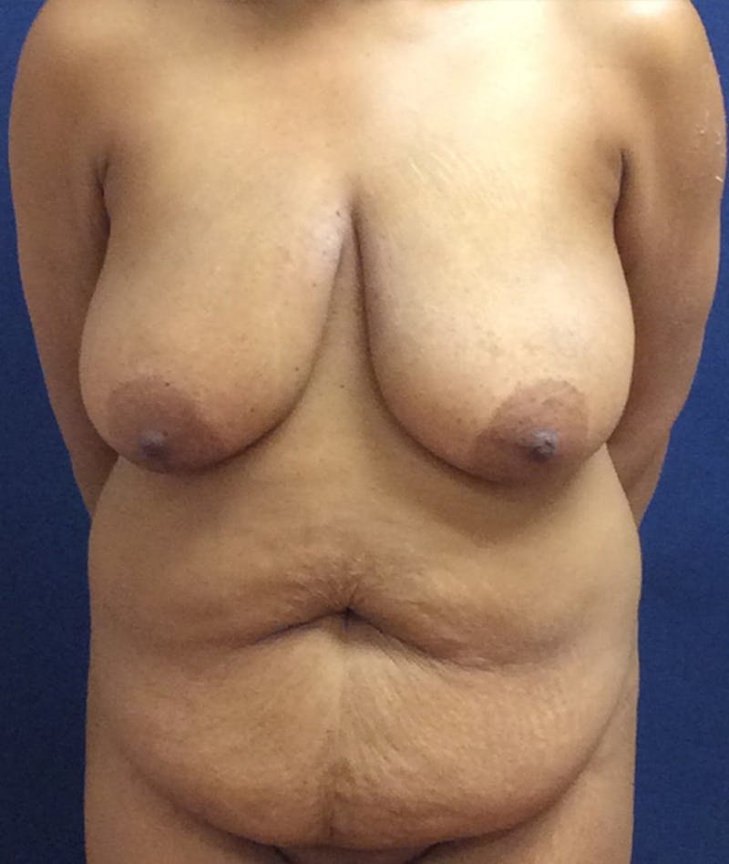 Mommy Makeover Before & After Gallery - Patient 151409 - Image 1