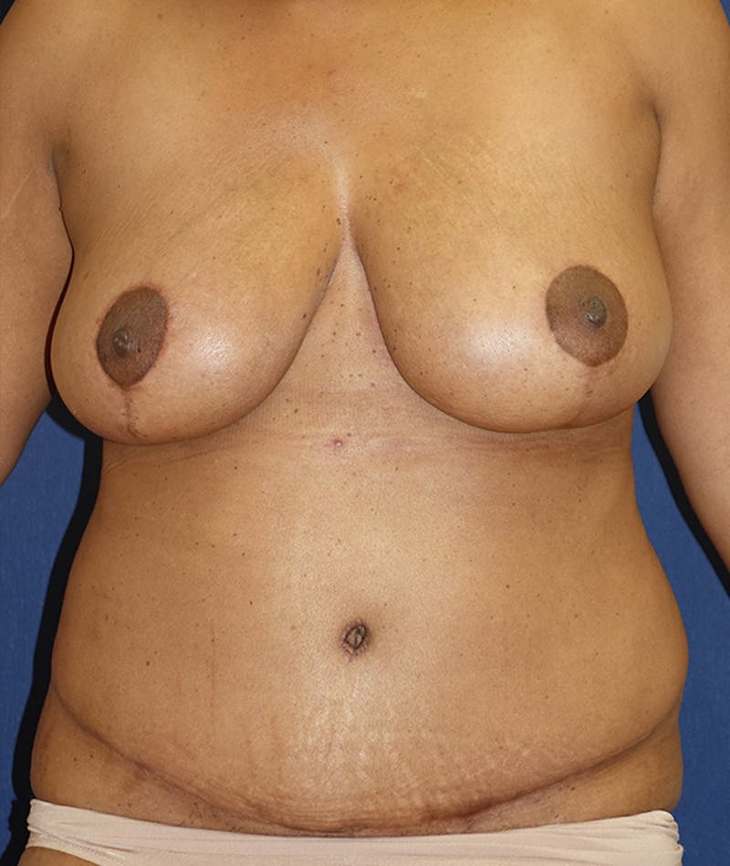 Mommy Makeover Before & After Gallery - Patient 151409 - Image 2