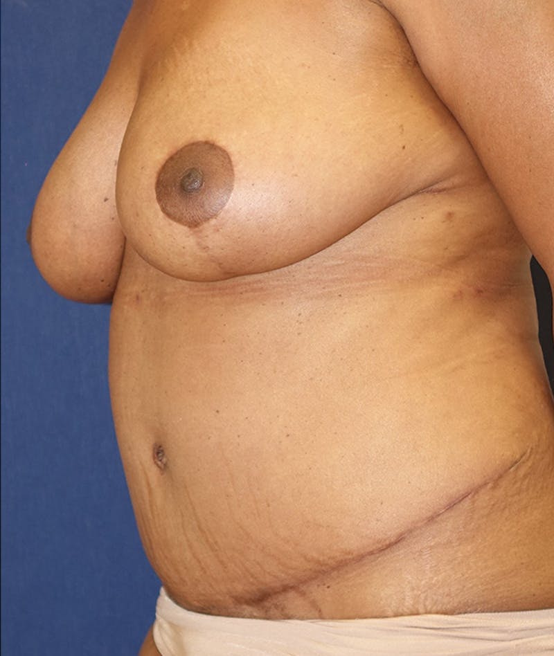 Mommy Makeover Before & After Gallery - Patient 151409 - Image 8