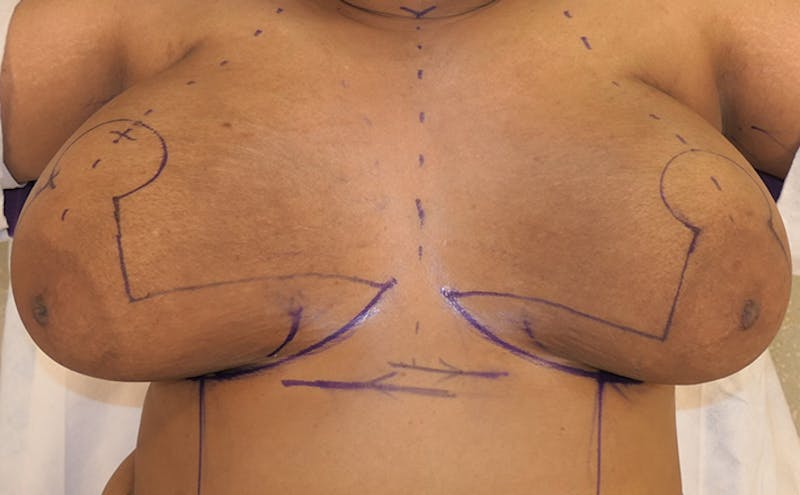 Breast Reduction Before & After Gallery - Patient 387650 - Image 11