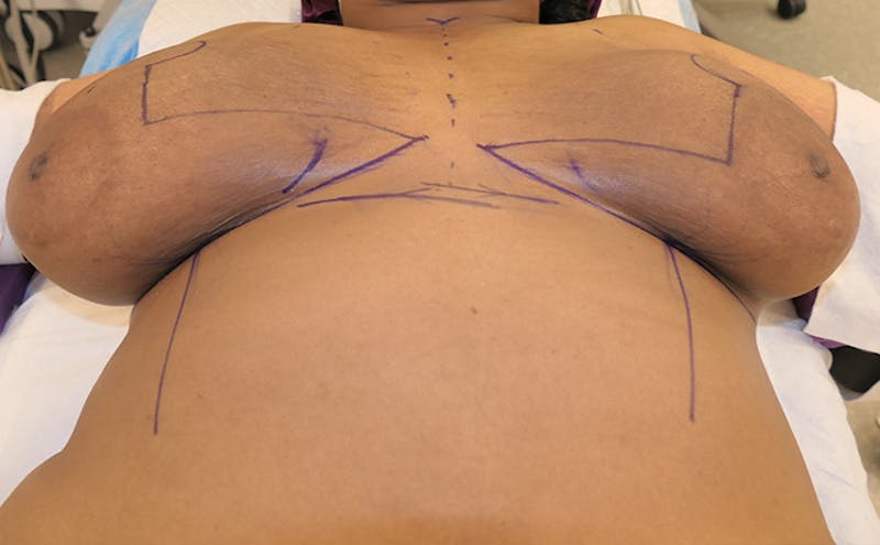 Breast Reduction Before & After Gallery - Patient 387650 - Image 13