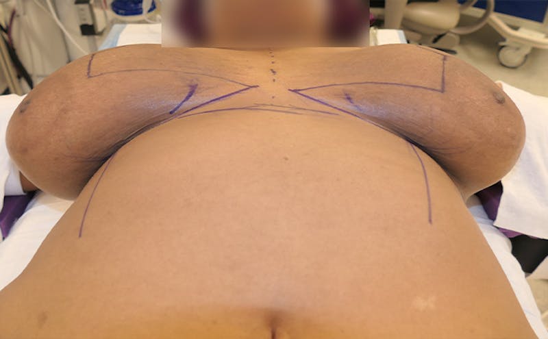 Breast Reduction Before & After Gallery - Patient 387650 - Image 15