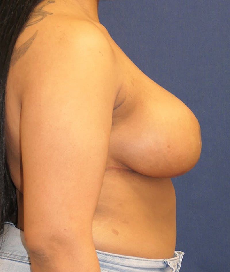 Breast Reduction Before & After Gallery - Patient 387650 - Image 6