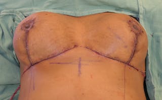 Breast Reduction Before & After Gallery - Patient 387650 - Image 14