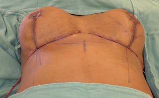Breast Reduction Before & After Gallery - Patient 387650 - Image 16