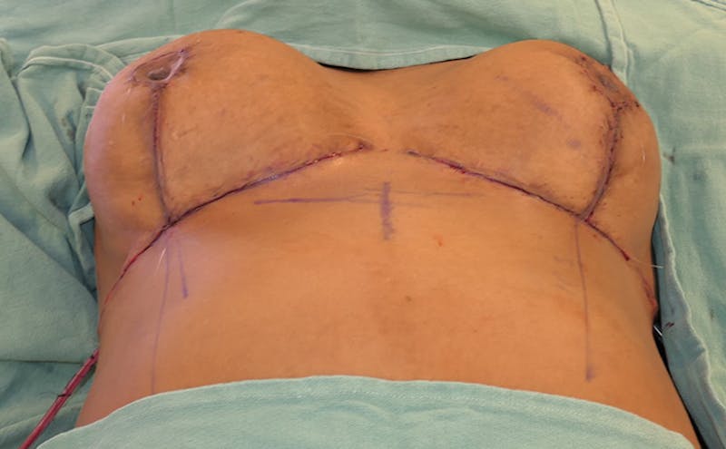 Breast Reduction Before & After Gallery - Patient 387650 - Image 16