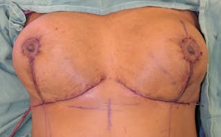 Breast Reduction Before & After Gallery - Patient 387650 - Image 12