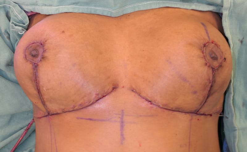 Breast Reduction Before & After Gallery - Patient 387650 - Image 12