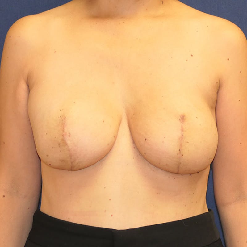 Breast Reconstruction with Implants Only Before & After Gallery - Patient 324999 - Image 2