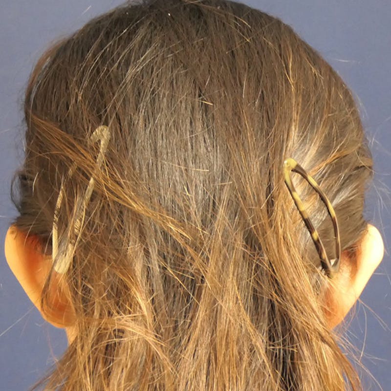 Ear Pinning (Otoplasty) Before & After Gallery - Patient 256429 - Image 5