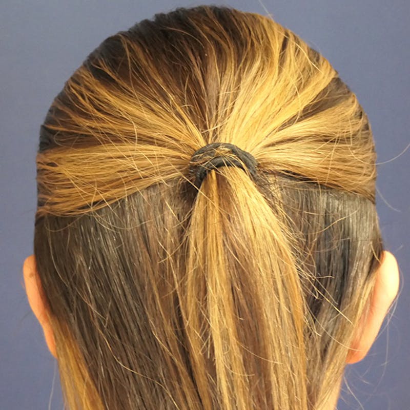 Ear Pinning (Otoplasty) Before & After Gallery - Patient 256429 - Image 6