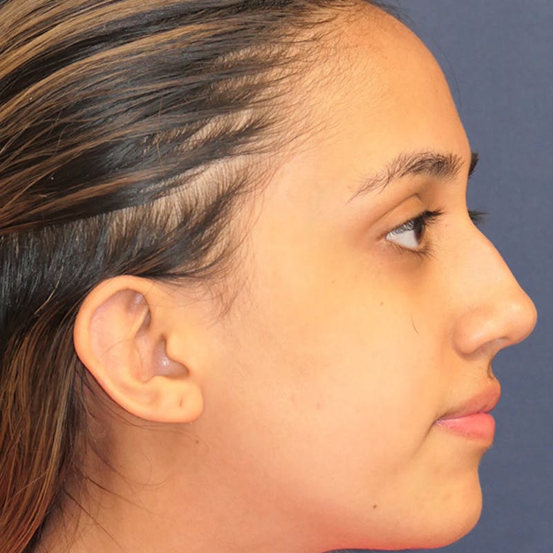 Ear Pinning (Otoplasty) Before & After Gallery - Patient 256429 - Image 4
