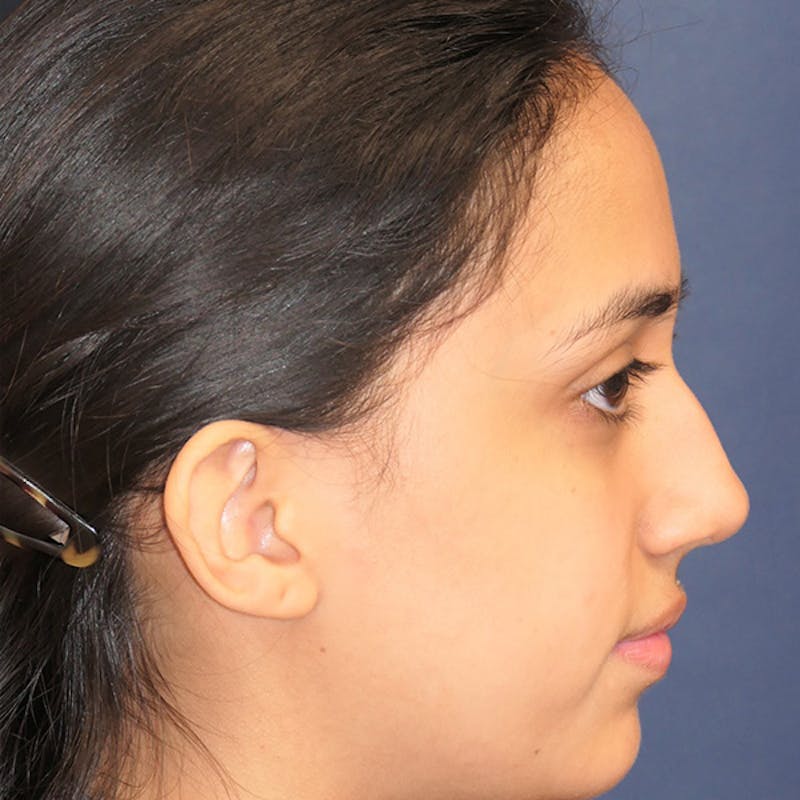 Ear Pinning (Otoplasty) Before & After Gallery - Patient 256429 - Image 3